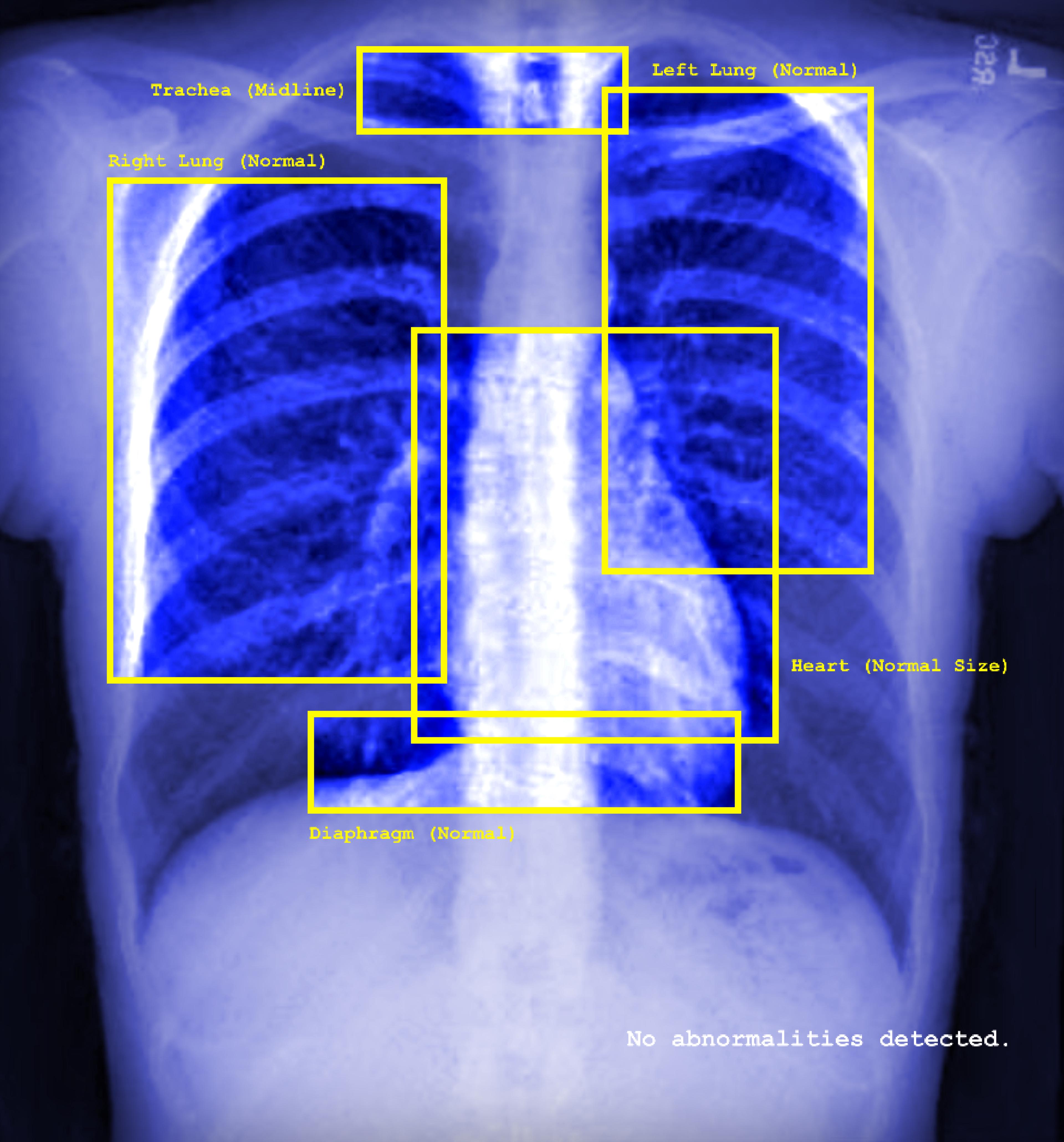 This image shows a blue xray image of a person's chest - it shows the ribs, the faint outline of a heart, and other organs. The image features yellow squares surrounding the organs (left lung, trachea, right lung, heart, diaphragm) - each of them feature labels such as: normal, midline, normal size. There is text in the right bottom corner in white which states 'no abnormalities detected'. 